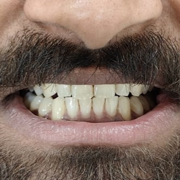 After Dental Treatment - Best Dentist in Baner