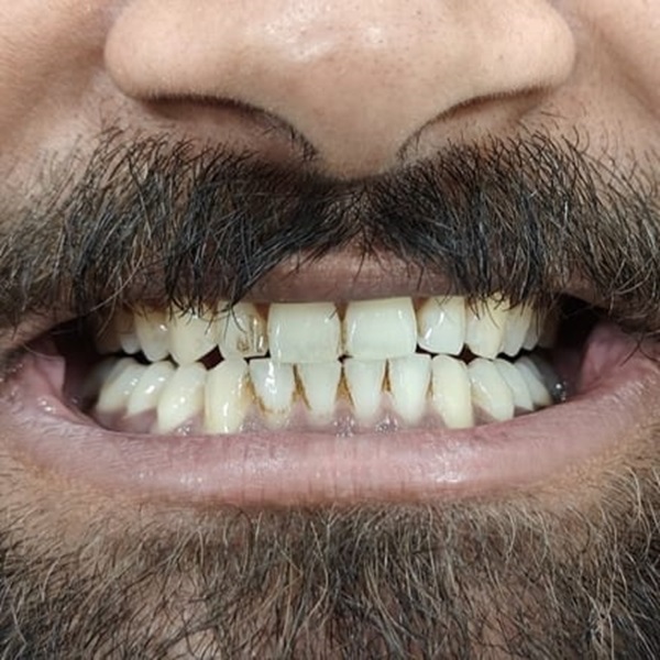Before Dental Treatment - Enamel Craft Dental Studio