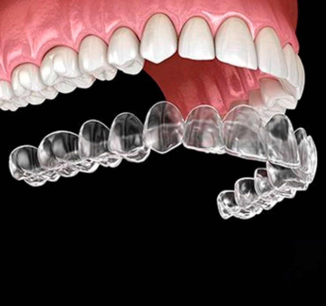 Teeth Aligners - Modern Braces for Adults