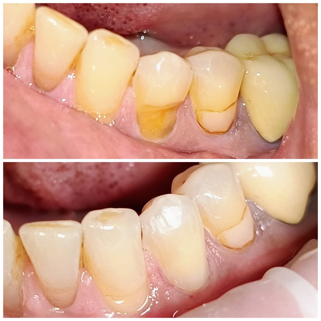 Composite Restoration - Natural-Looking Fillings