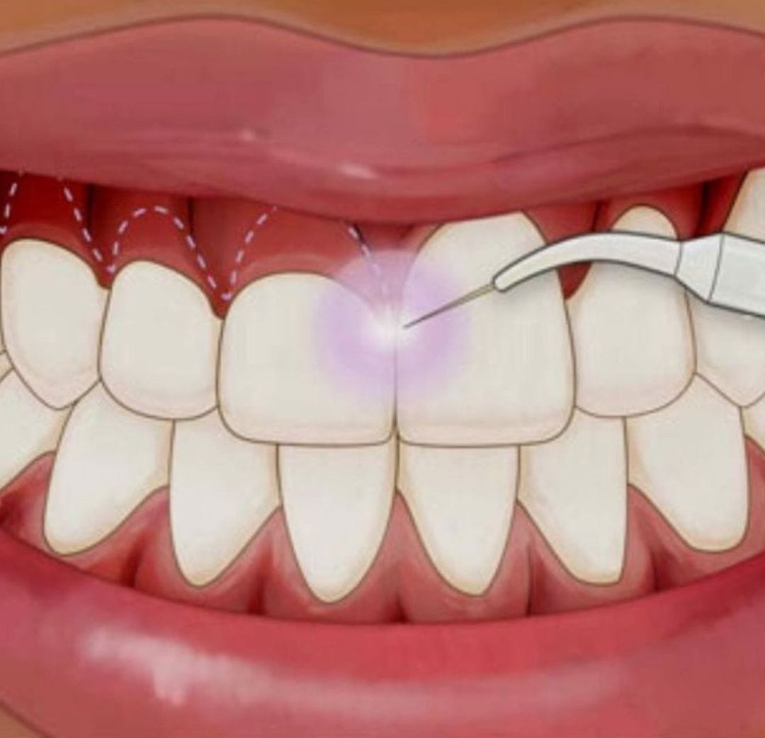 Crown Lengthening - Restoring Your Smile