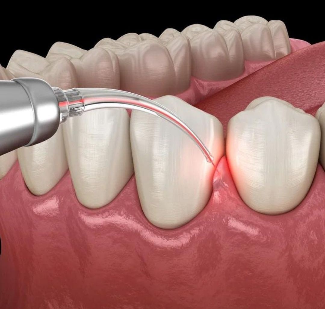 Laser Dentistry - Advanced Dental Treatment