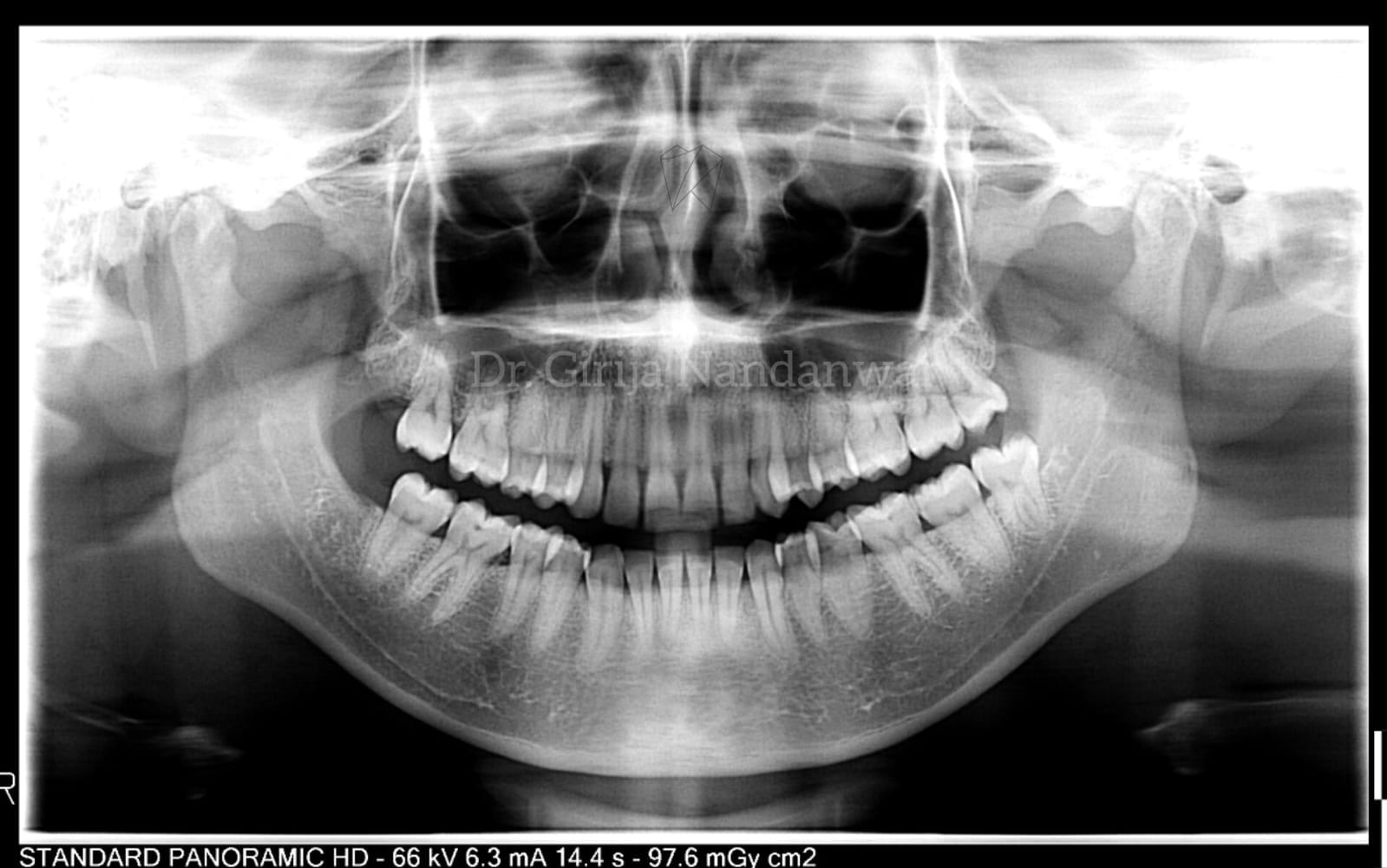 OPG Orthopantomogram - Comprehensive Dental X-Ray