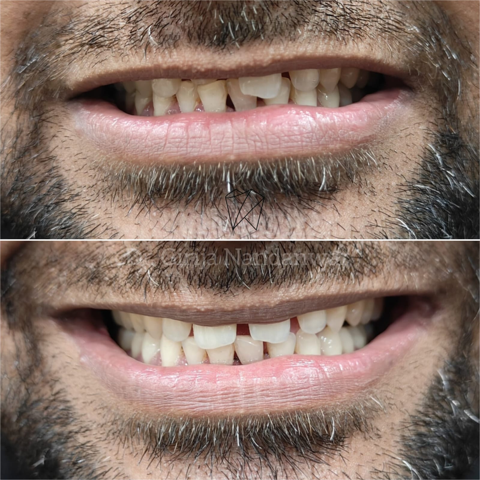 Full Mouth Rehabilitation - Complete Dental Restoration