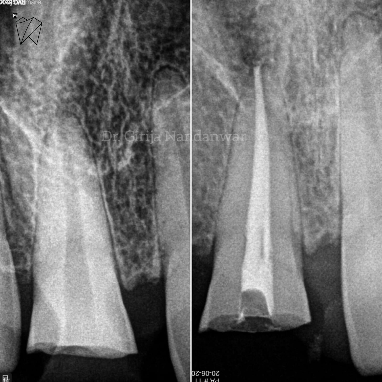 Painless Root Canal Treatment - Advanced Technology