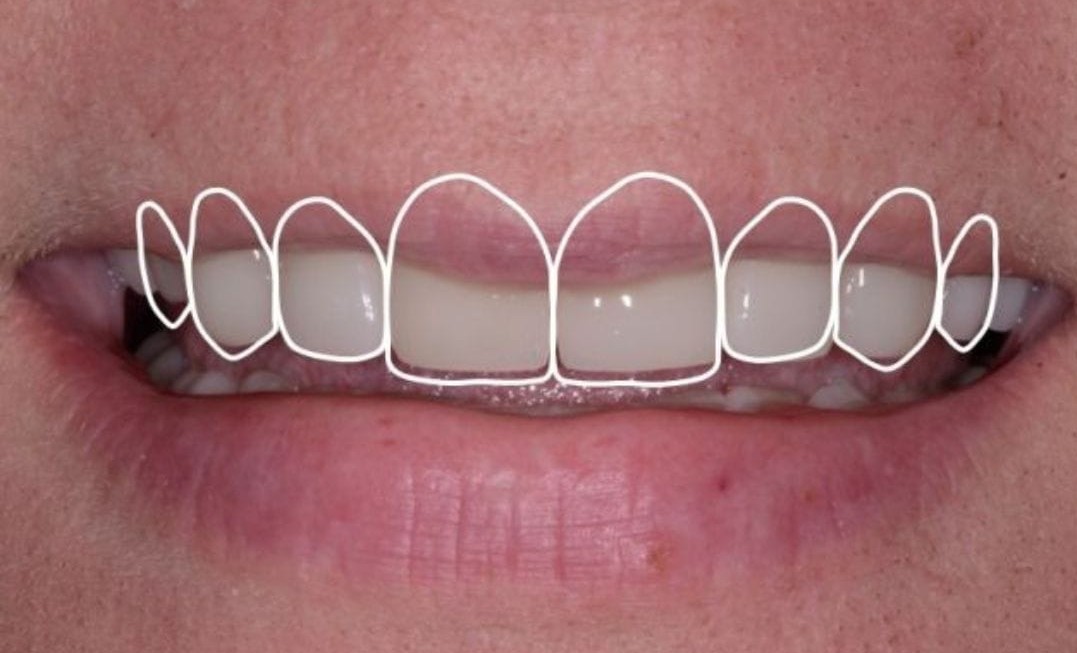 Digital Smile Design - The Future of Smile Makeovers