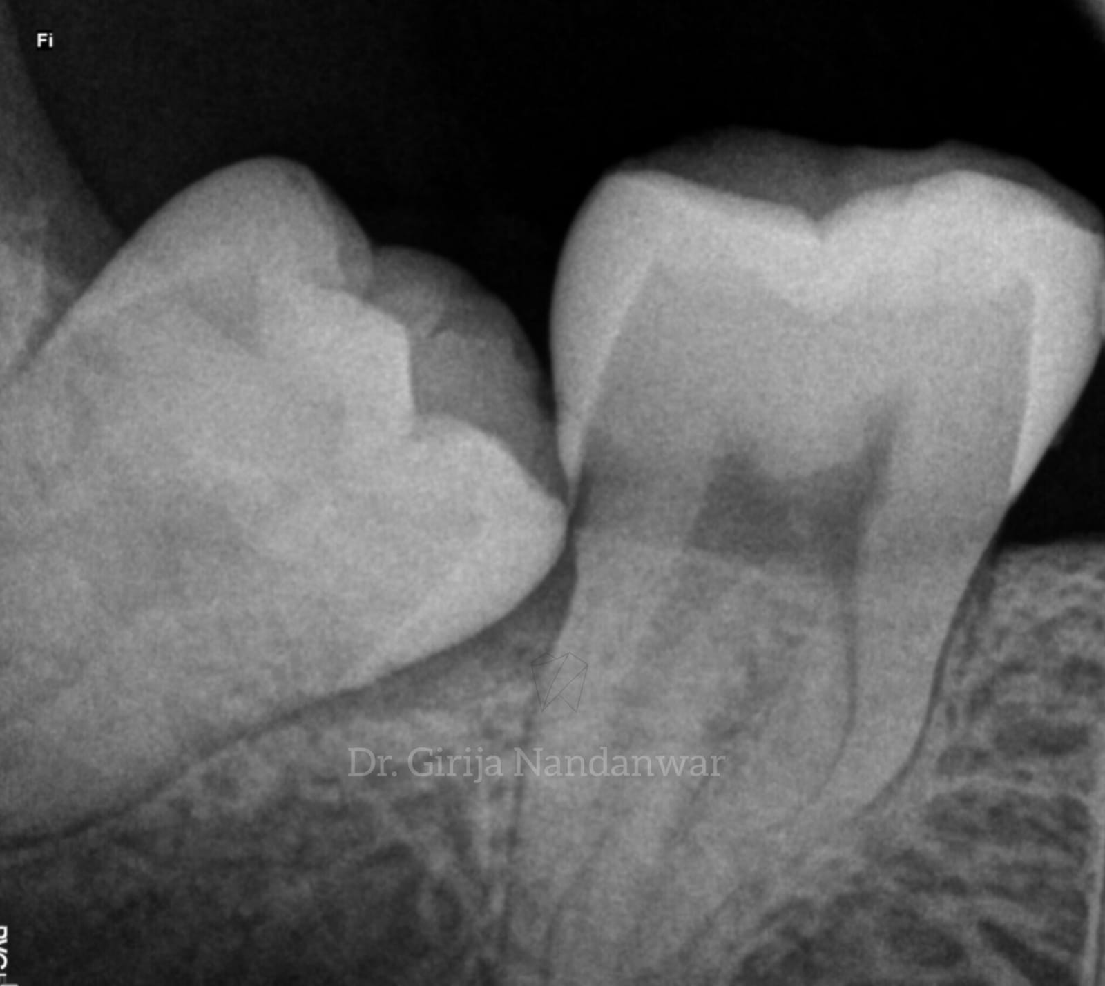 Wisdom Tooth Extraction - Safe and Painless