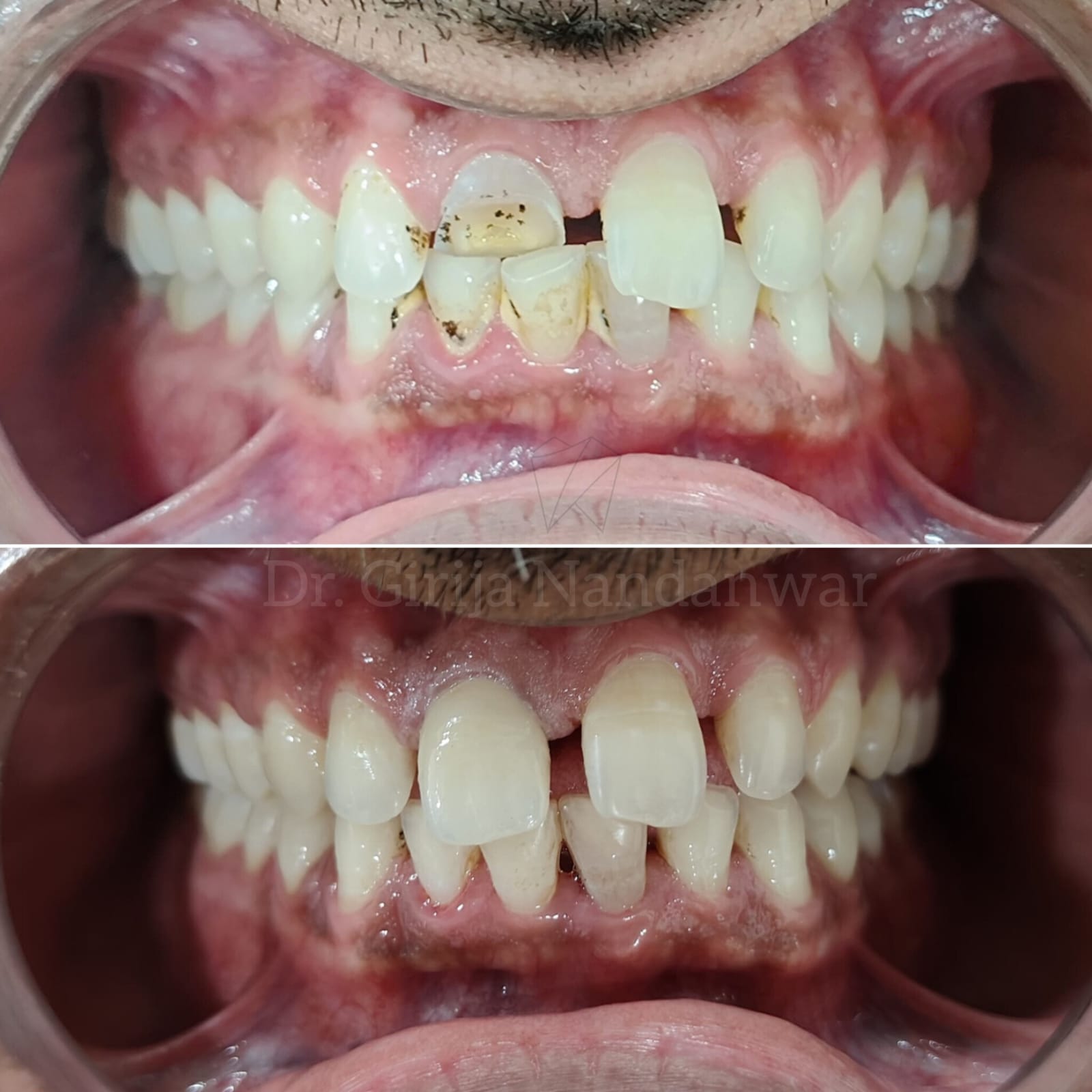 Zirconia Crowns - Durable and Aesthetic
