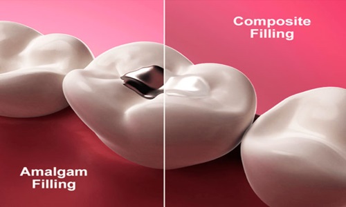 Composite Restoration in Baner
