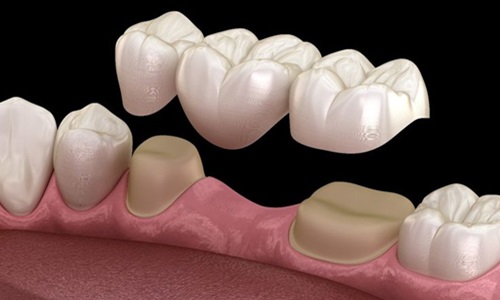 Dental Bridges for Missing Teeth in Pune