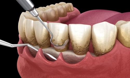 Dental Scaling and Polishing in Pune