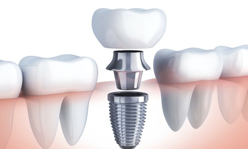 Best Dental Implants in Baner, Pune