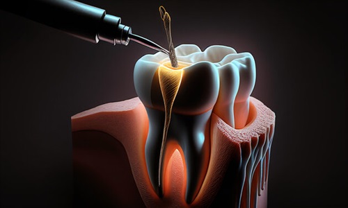 Painless Root Canal Treatment in Baner