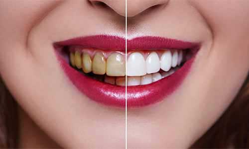 Teeth Whitening in Baner - Brighten Your Smile