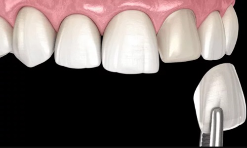 Best Veneers for a Perfect Smile