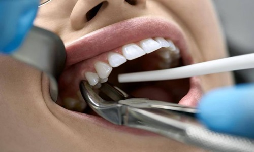 Wisdom Tooth Extraction by Expert Dentist