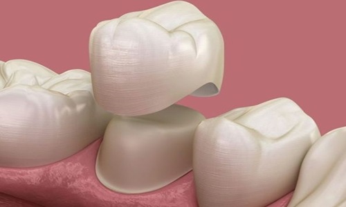 Zirconia Crowns for Durable and Aesthetic Teeth